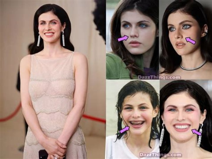 Alexandra Daddario Plastic Surgery Before and After
