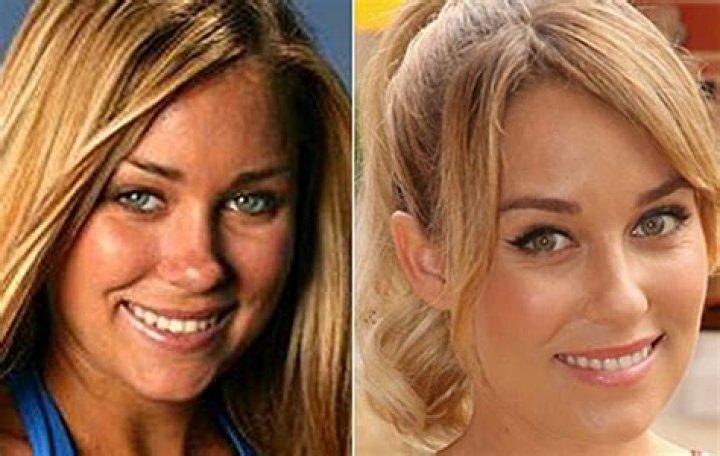 Lauren Conrad Plastic Surgery Before and After