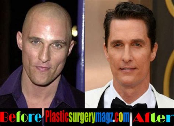 Matthew McConaughey Plastic Surgery Before and After