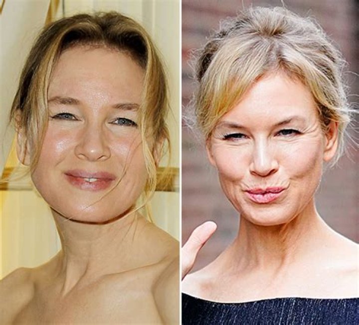 Renee Zellweger Plastic Surgery: Exploring the Truth Behind the Celebrity Facelift Speculation