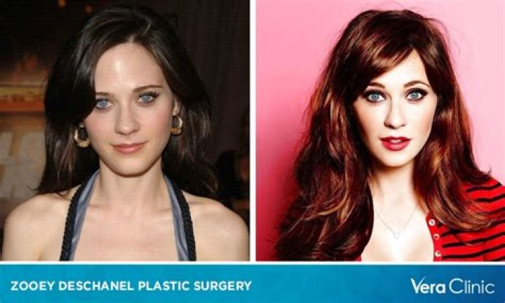 Zooey Deschanel Plastic Surgery Before and After